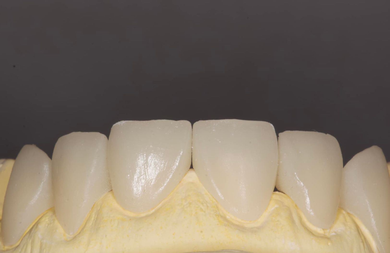 splint__97__6a418ee0bfd26.jpg