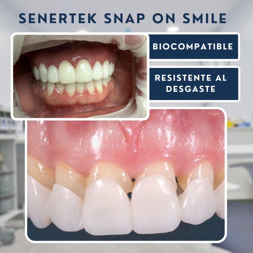 Senertek Snap On Smile - Imagen 3